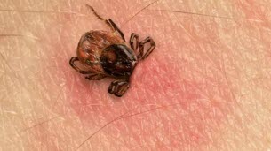 Haute-Savoie. « Une grosse fatigue qui peut aller jusqu’au coma » : alerte à l’encéphalite à tiques, entre vigilance et incertitudes