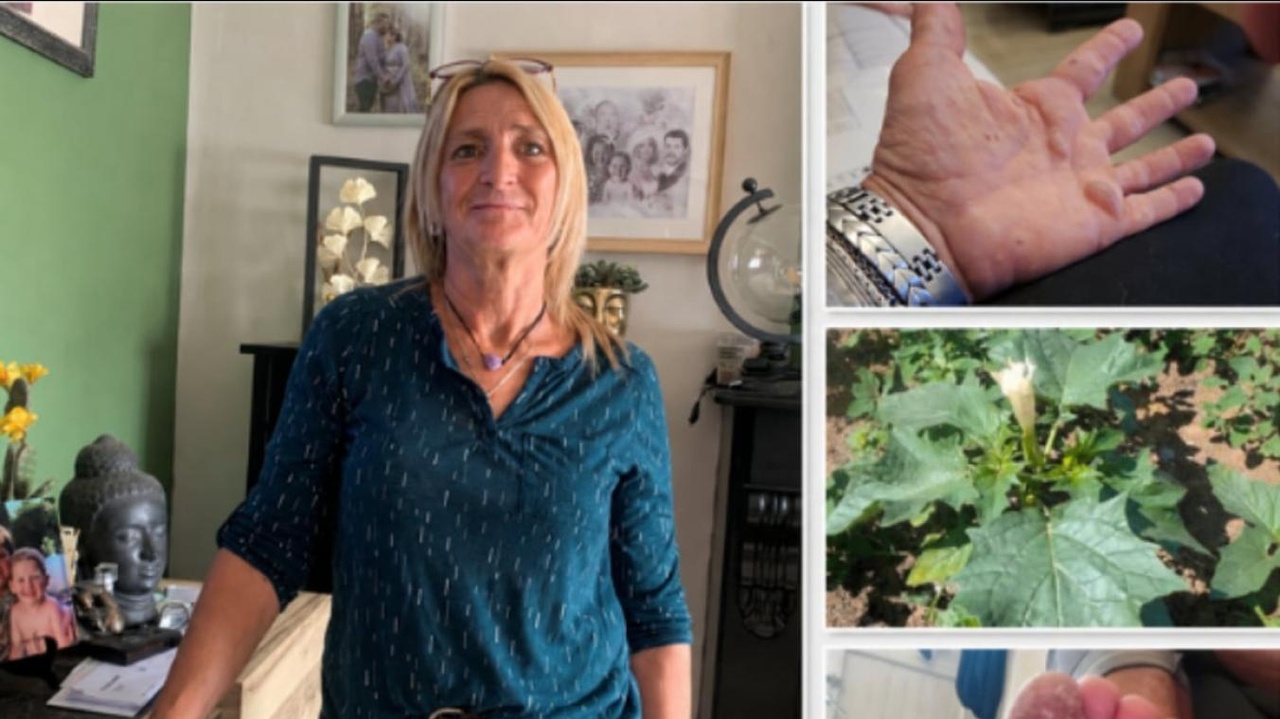 Valérie a été victime de « l’herbe du diable » à Basècles : « J’ai cru perdre mon orteil »