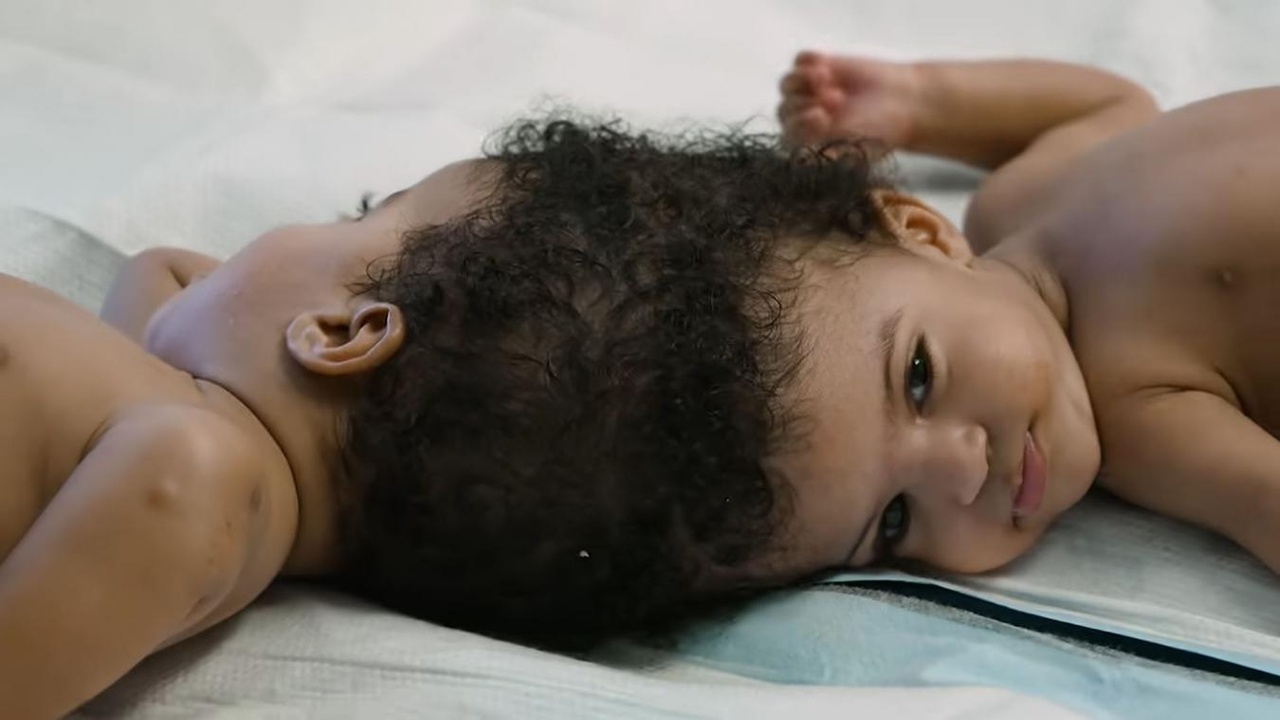 Pendant deux ans, ces deux soeurs ont vécu sans jamais pouvoir se voir face à face : une opération de 25 heures les sépare (vidéo)