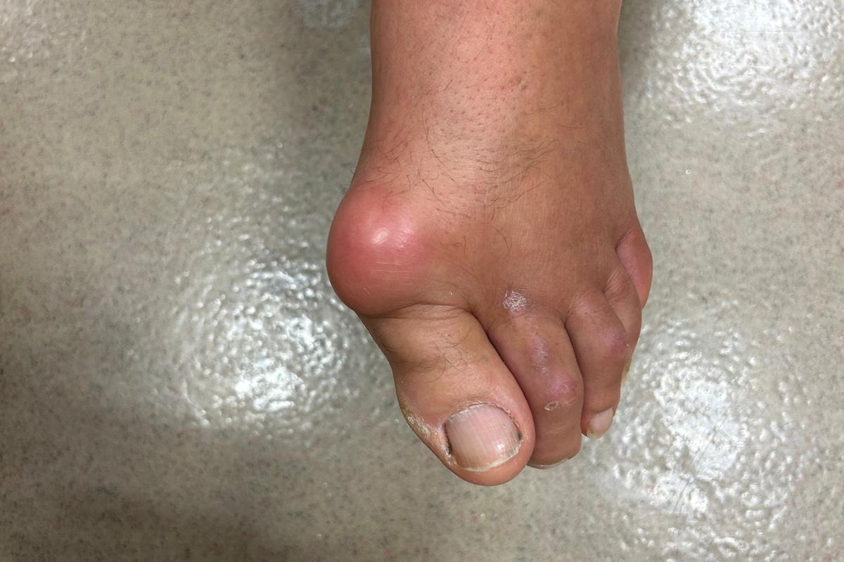 Bientôt une « clinique de la goutte » au CHU de Nice pour mieux prendre en charge cette maladie